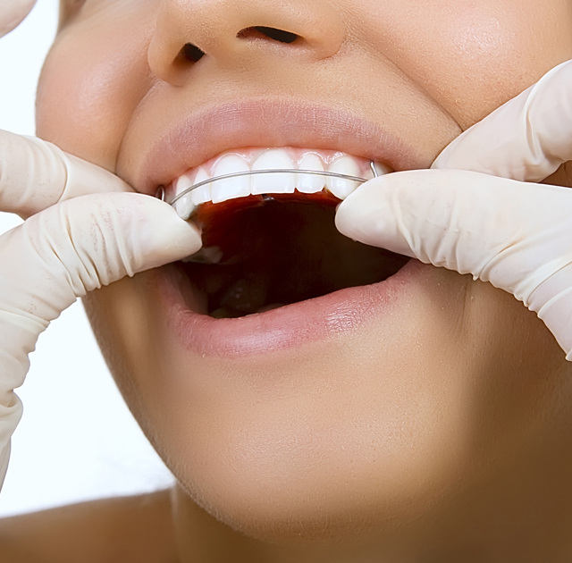 Retainers