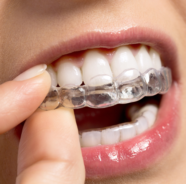 Clear Aligners